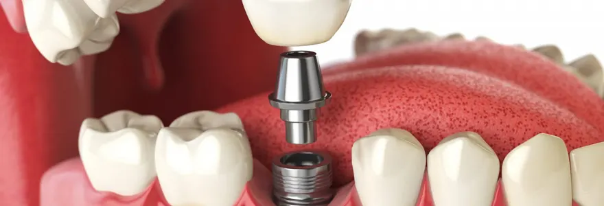 chirurgie des implants dentaires