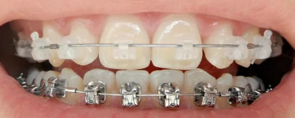 les differents types d appareils orthodontiques pour une correction dentaire reussie