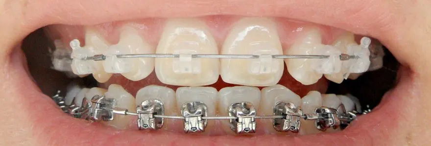 les differents types d appareils orthodontiques pour une correction dentaire reussie