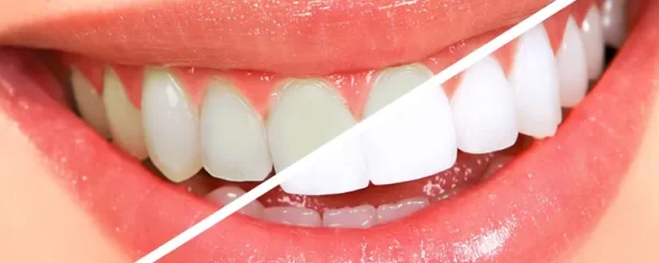 conseils pour retrouver des dents blanches