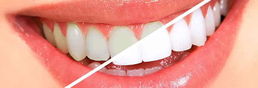 conseils pour retrouver des dents blanches