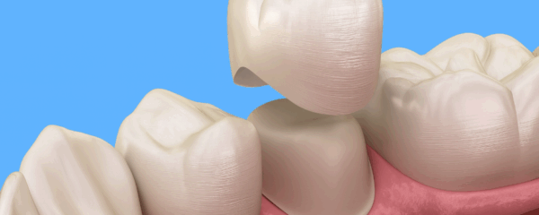 Couronne dentaire illustration