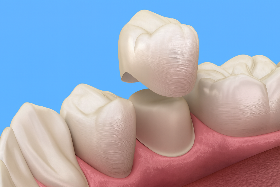 Couronne dentaire illustration